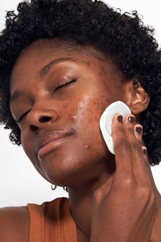 A lady cleaning her acne face